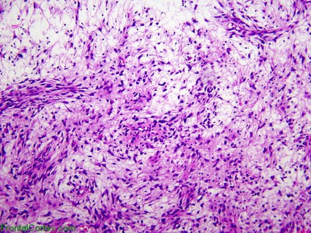 IIIrd ventricular glioma, H&E stain x100